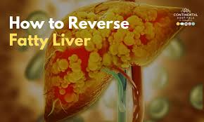 How Fatty Liver Develops and How to Reverse It Naturally